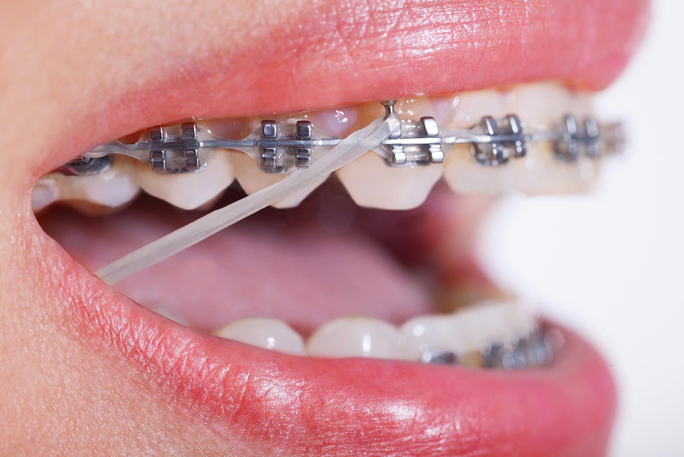 why elastics with braces