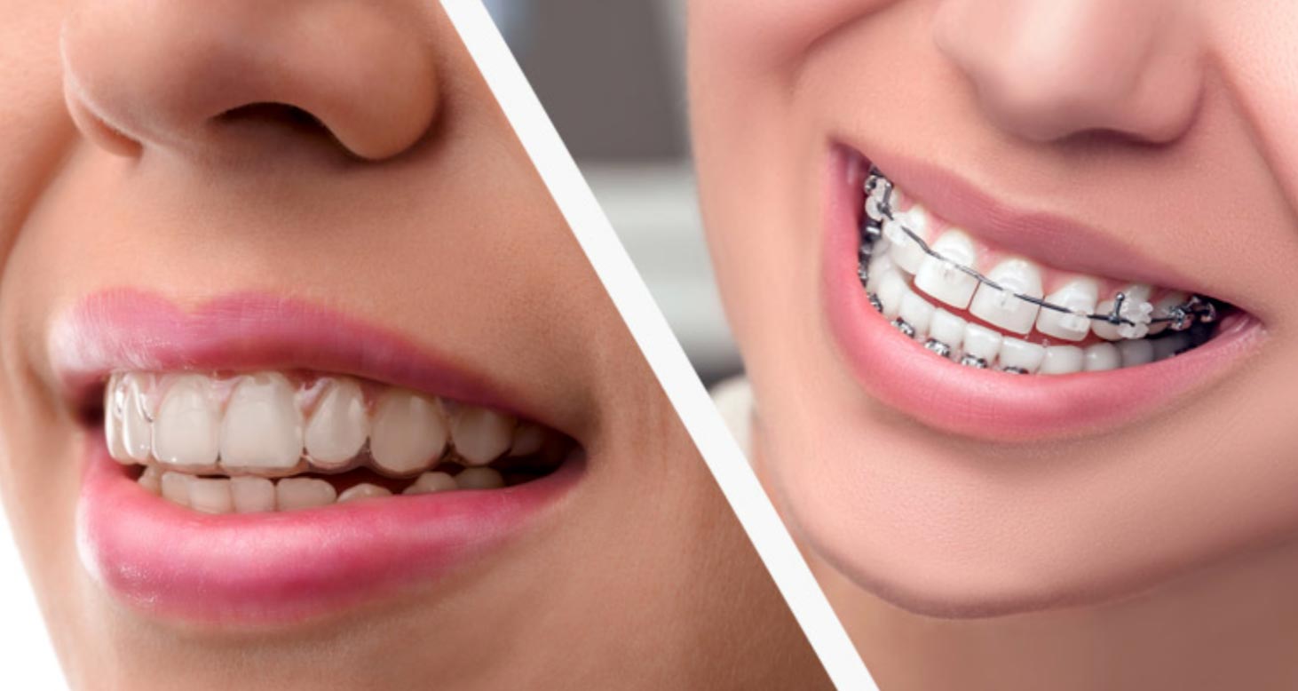 Invisalign vs. Braces : Farr West Orthodontics
